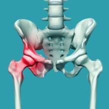 hip replacement surgery at ABC Clinic