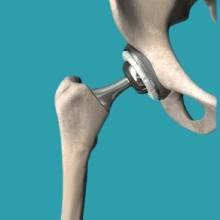 Total hip replacement surgery in Pune