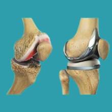 total Joint replacement