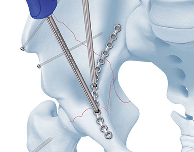 Pelvi-acetabular-Surgery