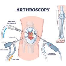 Arthroscopy Surgery in Pune