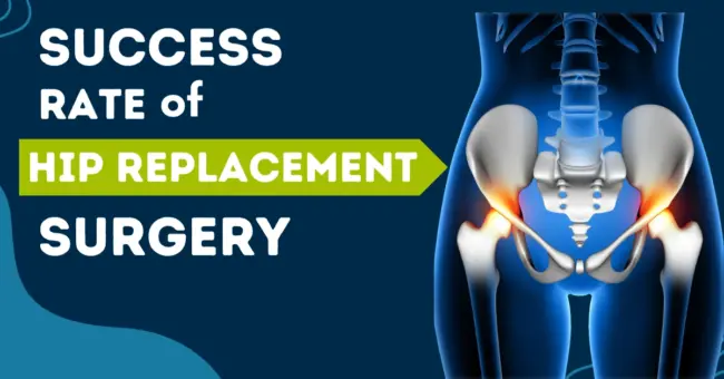 Success rate of hip replacement surgery Success rate of hip replacement surgery in india