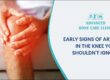 Early signs of arthritis in the knee