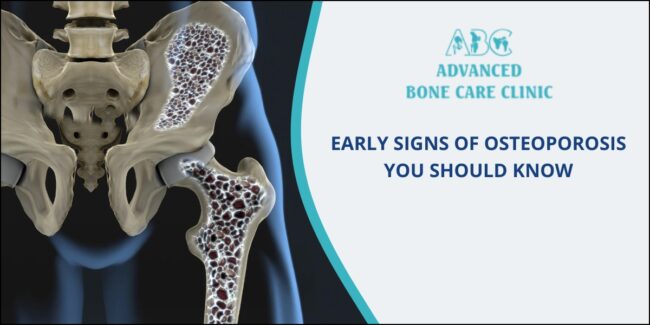 Osteoporosis - Complete Guide
