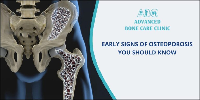 Osteoporosis - Complete Guide