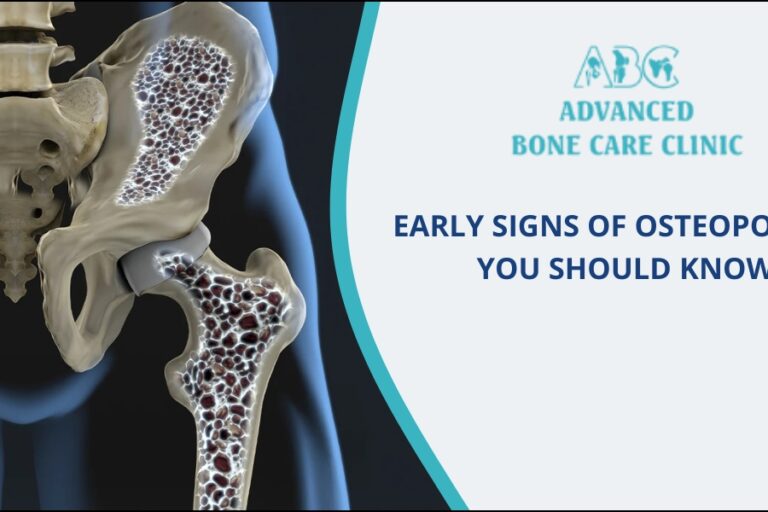 Osteoporosis - Complete Guide